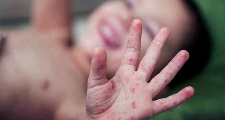  La OMS advirtió sobre el crecimiento de los casos de sarampión en el mundo 