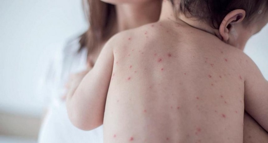  Hay otro caso de sarampi&oacute;n en la Ciudad de Buenos Aires y ya suman tres en el pa&iacute;s 