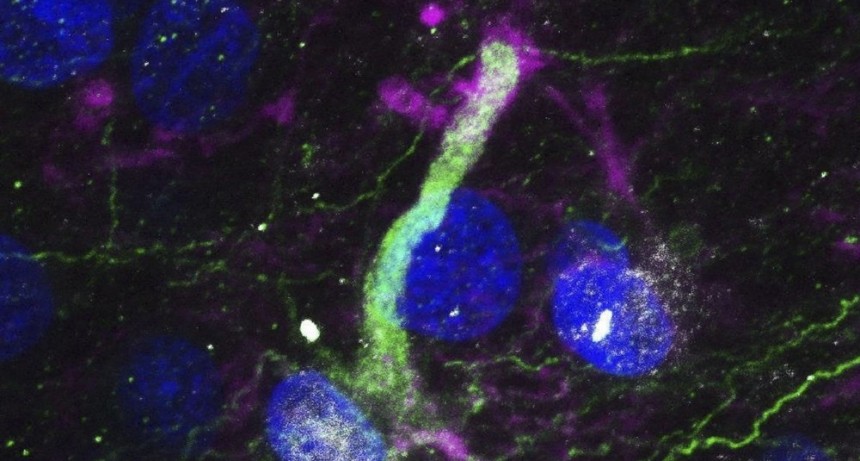  Un estudio comprobó que la acumulación de una proteína permite la detección temprana del Parkinson 
