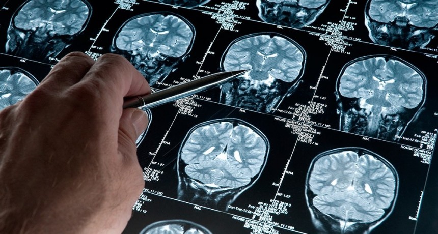  Científicos de la UBA investigan cómo detectar el alzheimer con inteligencia artificial 