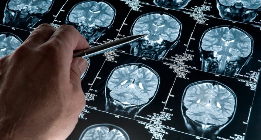  Alzheimer, la enfermedad que ahora puede ser detectada 20 años antes de la aparición de síntomas 
