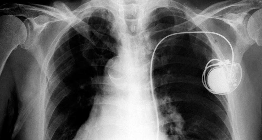  Buscan mejorar los marcapasos implantables con un análisis detallado del ritmo cardíaco 